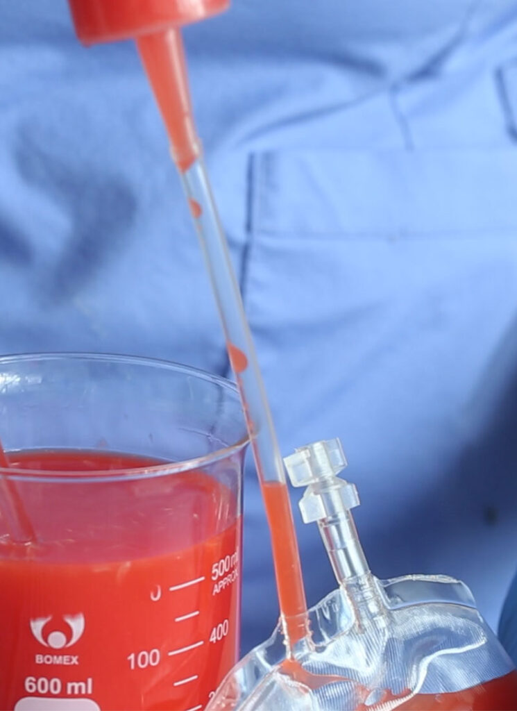 IV blood bags are being filled with juice with the help of a syringe.