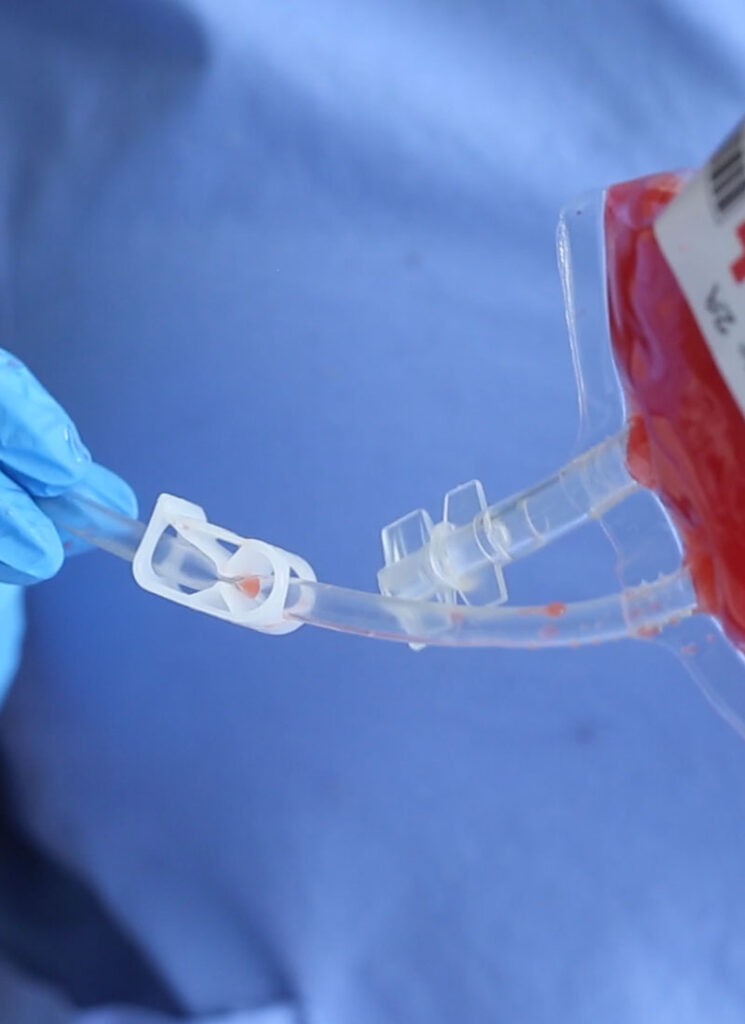 A stopper is placed on the tube of a blood bag filled with a red cocktail. It is being held with gloved hands.